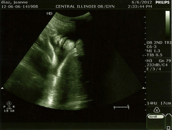 Sonogram at 30 weeks. If you look closely in the upper left corner you'll see nose, lips, and a chin that look EXACTLY like Jason's.